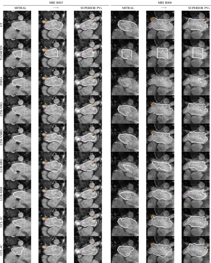 Fig. 6: Axial slices from the MRI datasets are displayed from the mitral to the PVs plane