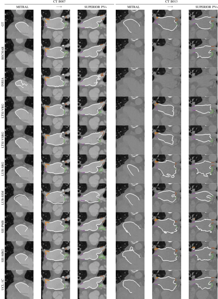 Fig. 4: Axial slices from the CT datasets are displayed from the mitral to the PVs plane