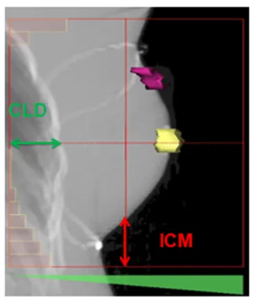 FIGURE 1 | Description of the inferior central margin and central lung distance on a digital reconstructed radiography performed on the treatment planning system Isogray ® according to Fein et al