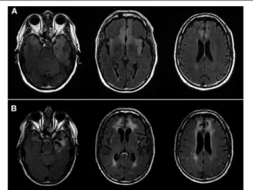 FIGURE 1 | 3T Brain MRIs. (A) Patient N ◦ 1 MRI at the acute phase of the herpetic meningoencephalitis