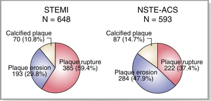 Figure 2. Prevalence of plaque rupture, erosion, and calciﬁed plaque in ST-segment–elevation myocardial infarction and non–