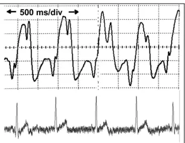 Fig.  4.  (top)  typical  raw  signal  from  microwave  sensor. 