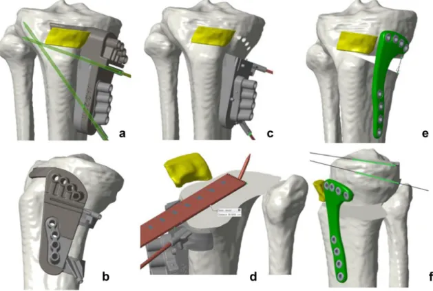 Fig. 1    Preoperative 3D templating illustrating the operative technique  of custom cutting guides