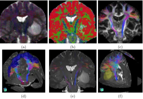 Fig. 2. Illustration of Patient 2’s CST. (a,b): Estimated DDI models overlaid on the B0 and on the map of number of detected fixels (blue: 1, green: 2, red: 3)