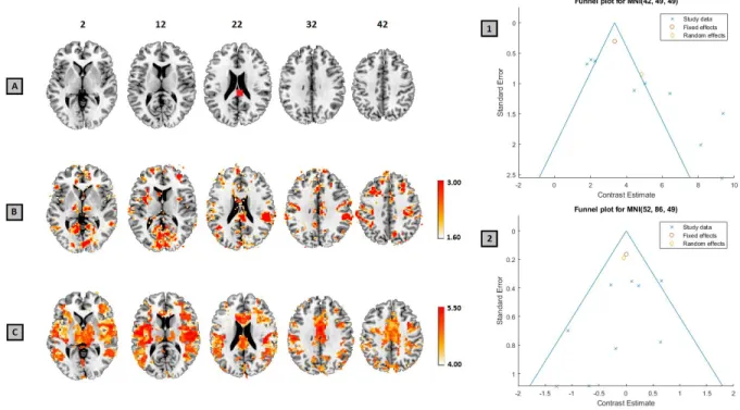 Figure 2: Site where bias was induced, shown in red (A), the unweighted Egger’s Regression -log 10  p-value map thresholded using an FDR-corrected p<0.05 (B) and the Trim and Fill L estimator of number  of studies missing due to publication bias, thresh