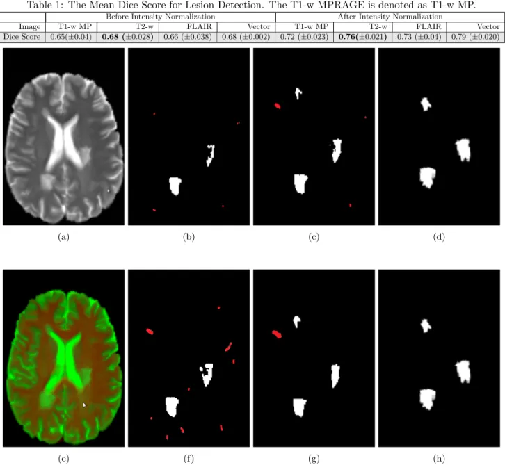Table 1: The Mean Dice Score for Lesion Detection. The T1-w MPRAGE is denoted as T1-w MP.