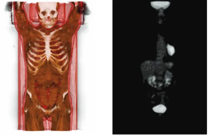 Fig. 2. Multimodal visualization of CT / PET images. The two images – viewed here separately for the sake of readability – are fused (volumic rendering) and visualized in 3D (autostereoscopic device) under the MINT Software (https://mint.univ-reims.fr)