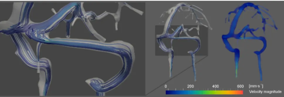 Fig. 3. Blood flow simulation in a cerebral venous network: streamlines and velocity fields.