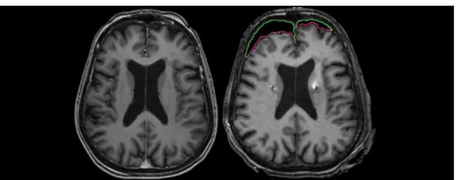 Fig. 1: Pre-operative (left) MR image without brain shift, and post-operative (right) MRI showing asymmetric brain shift