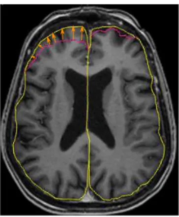 Fig. 3: Measure of similarity to be minimized: the triangular surface extracted intra-operatively, represented by a pink contour in this pre-operative axial MRI, is projected on the simulated brain surface (yellow contour)