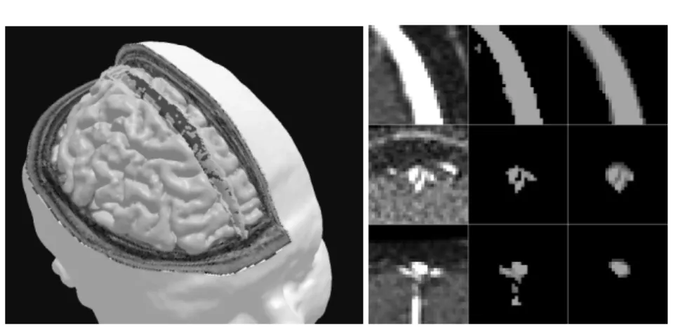 Figure 4. Left: flowing blood surrounded by the SSS wall. Right: results provided by the proposed method and a region growing method