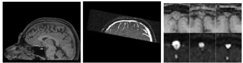 Figure 1. Left: T1 MRI sagittal slice of the whole head. Middle: MRA sagittal slice of the top of the head