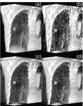 Figure 1: Coronal slice of patient with lung tumor, in end-inhale position (a) Static FDK (b)  Respiration-correlated FDK (c) ROOSTER with null DVF (d)  MC-ROOSTER with DVF estimated on the planning CT