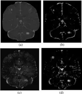 Fig. 4. The same difference slice between MRI and Gd-enhanced MRI respectively without (a), with histogram standardization(b), USPIO-enhanced MRI respectively without (c) and with histogram standardization (d)