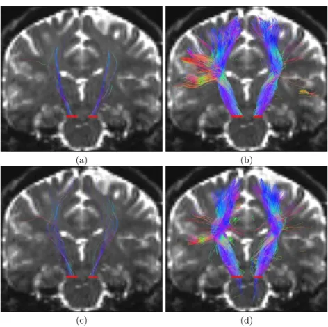 Fig. 4. Tractography of the Left and Right Corticospinal Tracts. Coronal view of both corticospinal tracts using the four proposed methods: (a): DTI mono, (b): DTI multi, (c): ODF mono, (d): ODF multi