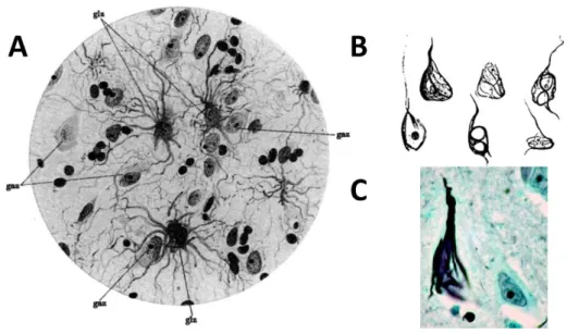 Figure  3 :  Dessins  des  d égénérescences  neurofibrillair es  observées  dans  le  cerveau  d’Auguste  D., réalisés par Dr Alzheimer (A, B), et microphotographie d’un neurone comportant des NFT (C)