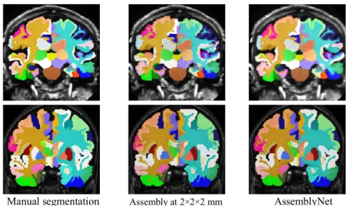 Fig. 1 shows segmentation in the native space for a subject from the OASIS dataset  and one for the CANDI cohort