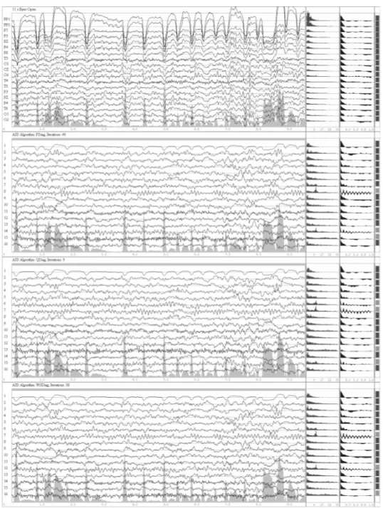 Figure 1. Top: about 9 s of a 11 s epoch extracted from the raw EEG recording of a 12 y.o