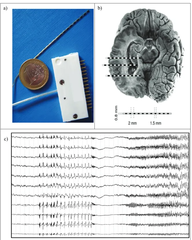Fig.   1.2. Exploration stéréo-électro-encéphalographique (SEEG) : (a) une photo d'une  électrode intracérébrale, (b) un exemple d'implantation d’électrodes dans le lobe temporal, et  (c) un exemple des signaux SEEG enregistrés sur 11 plots adjacents d’une