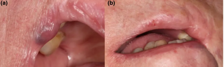 Figure 2 (a): 15 mm venous lake on the inner side of the right upper lip. The patient complained of chronic biting and bleeding.