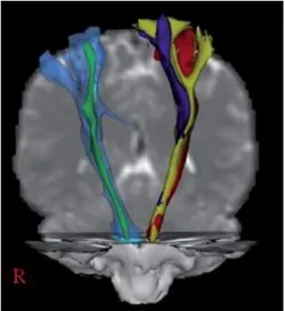 Figure  1-5 :  Tractographie  du  faisceau  cortico-spinal  réalisée  en  imagerie  par  tenseur de diffusion (DTI), vue antéro-postérieure