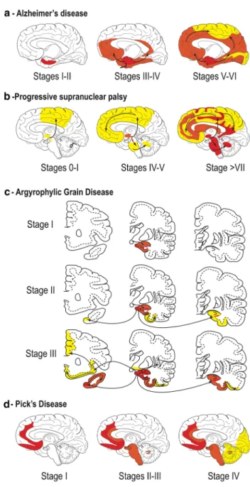 Fig. 4    a Staging of tau pathology in AD. Topographic distribution  of tau lesions at the different stages of tau pathology in schemes of  brains in medial views