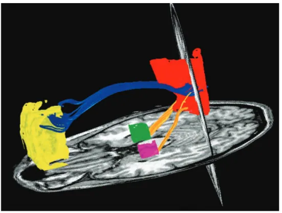Figure 1.8 – Anatomie du réseau du mode par défaut. Structures corticales : en jaune : le cortex préfrontal médial ; en rouge : le cortex cingulaire postérieur et précunéus ; en vert et rose : gyrus para-hippocampique