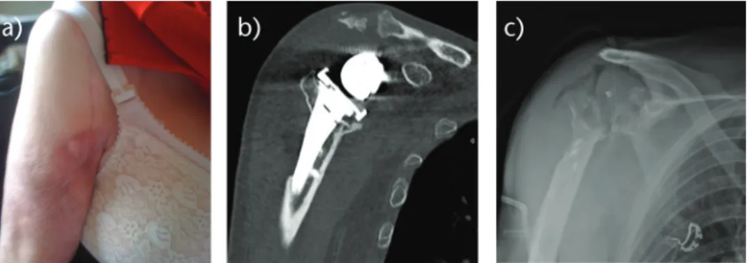 Fig. 1  a) Radiograph of a 73-year-old man with a chronic periprosthetic shoulder infection of a reverse shoulder arthroplasty (RSA)