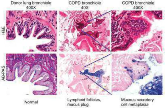 Figure 5 : Accumulation de mucus dans les bronchioles des patients BPCO 52