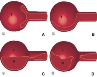 Figure 4 : Mécanismes de  malperfusion des artères  collatérales de l’aorte 