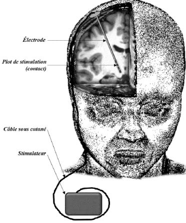 Figure 1.1: Illustration de la stimulation cérébrale profonde : les électrodes de stimulation (avec usuellement 4  contacts de stimulation où le courant est délivré) sont implantées dans une cible cérébrale et connectées à un  stimulateur qui génère le cou