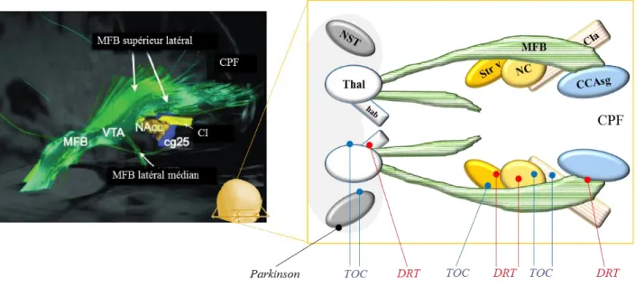 Figure  1.2:  Les  cibles  fréquemment  utilisées  pour  la  SCP  chez  les  TOC,  les  patients  DRT  et  les  patients  parkinsoniens, se situant autour du MFB (image de tractographie de ce faisceau de fibres et des régions cibles  de la SCP (Volker Arnd