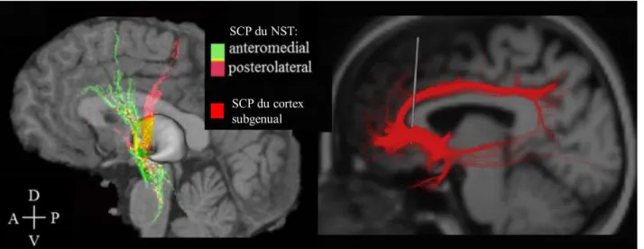 Figure 1.4: Effets étendus de la SCP. Etudes par MTA des fibres passant par les cibles d’implantation de la SCP  pour les 3 pathologies étudiées ici: le NST antéromédial pour les patients TOC (en vert), le NST postérolatéral  pour les patients parkinsonien