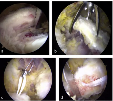 Figure 2 Second step. Posterior viewing portal of a right shoulder. (A) The glenoid neck is abraded with a motorized rasp