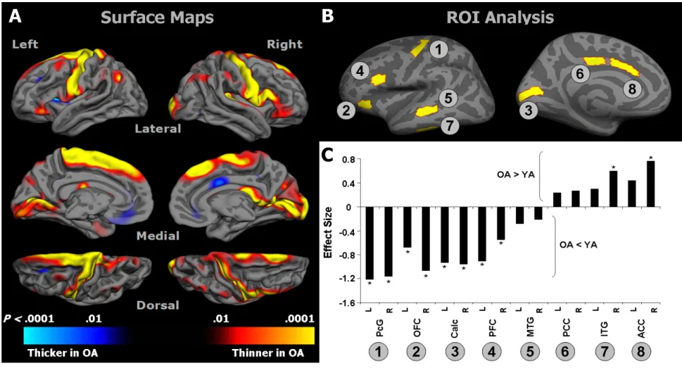 Figure 2.  A) Surface-based vertex-wise GLM maps showing differences between OA and YA in cortical thickness