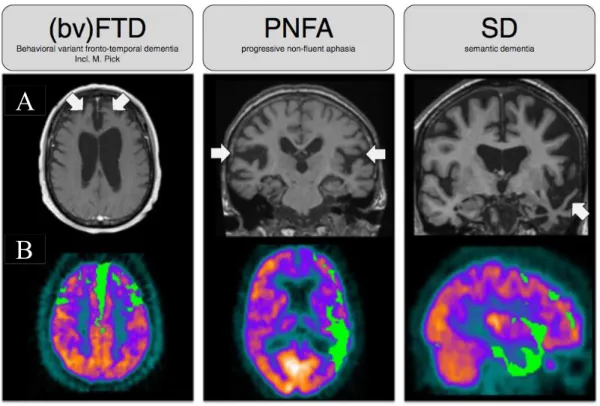 Figure 10  Overview of FTD alterations – Brain images