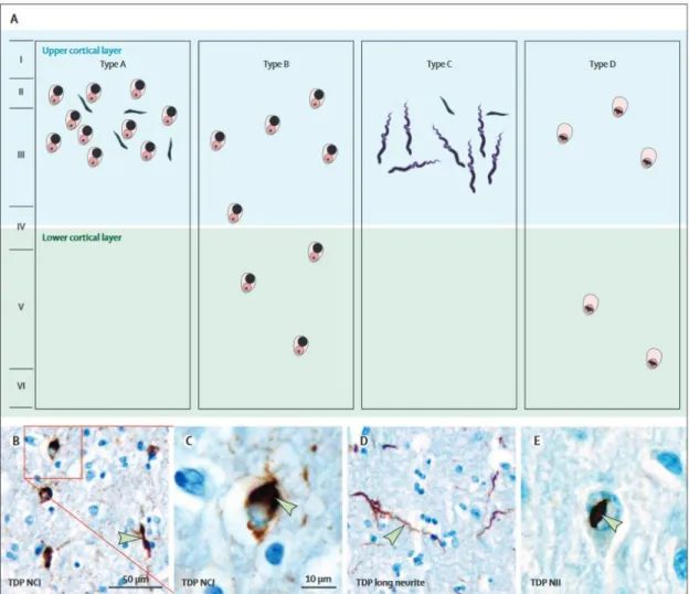 Figure 11  Pathological inclusions of TDP43 found in FTD and ALS