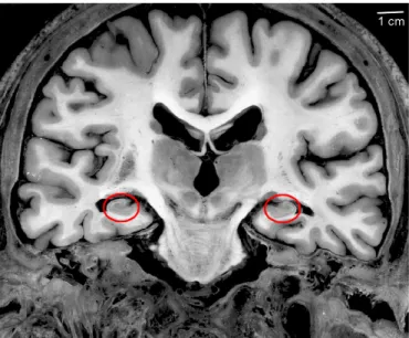 Figure 2.3: Coronal view of the hippocampus. The hippocampal region is circled in red.