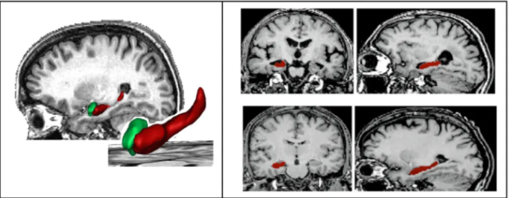 Figure 2.19: SACHA: Automatic segmentation of hippocampus and amygdala. Left panel: