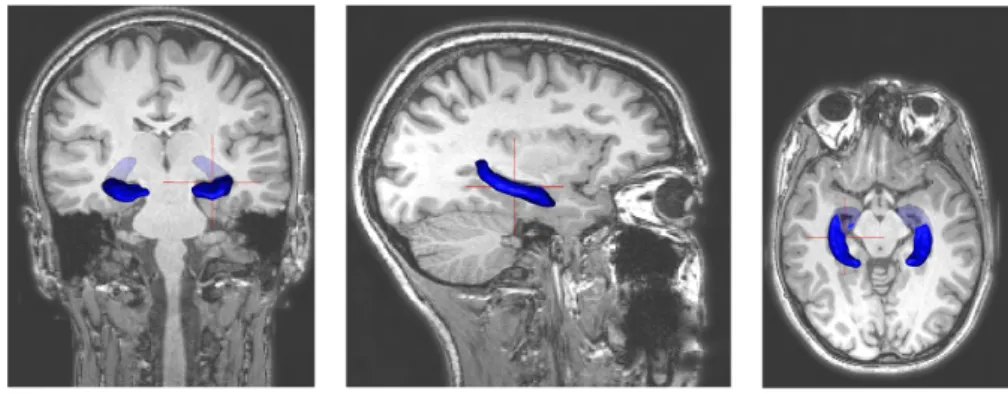 Figure 2.20: Coronal, sagittal and axial MRI views of the hippocampus. A 3D structure is superposed to the scans for a better representation.
