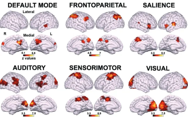 Figure 1.3: Regions showing higher functional connectivity in MCS patients as compared to VS/UWS patients (extracted from Demertzi et al