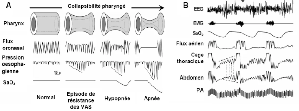 Figure  1 :  Evènements  respiratoires  et  enregistrement  polysomnographique  observables lors des apnées,  d’après Dematteis et al