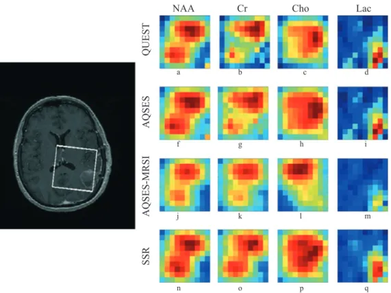 Figure 10. In vivo 3D MRSI acquisition on a resected Glioblastoma multiforme patient with a left parietal lesion associated with a thin peripheral contrast-enhancement