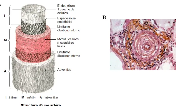 Figure 2: Structure schématique de la paroi artérielle (A) et illustration d’une artère pulmonaire  remodelée au cours de l’HTAP (B)