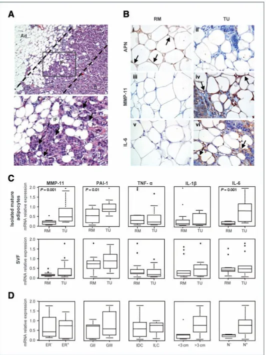 Figure 5. CAAs from human breast tumor exhibit extensive phenotypic changes in accordance with the in vitro coculture assays