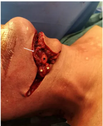 Fig. 1. Surgical anatomy of the submandibular gland. a: facial artery; b: facial vein;