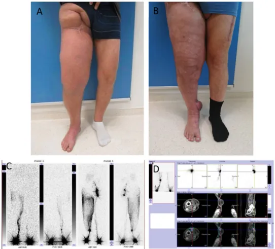 Fig. 4. Appearance of the lower limb preoperatively (A) and 5 months postoperatively (B)