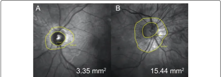 Fig. 3 Representative infra-red optic nerve images of 34 years old female with Stickler syndrome (a) and of 33 years old female enrolled as control (b)