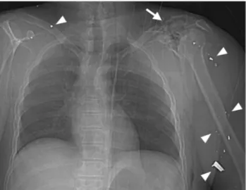 Figure 4. Part of a topogram at chest level showing mul- mul-tiple ballistic fragments (arrowheads) in the soft tissues of the right lower neck and the left upper arm