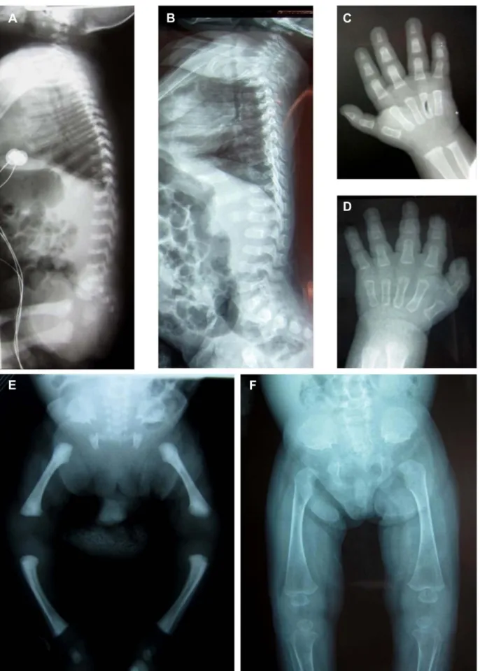 Figure 1. Radiological features of the patients F2-IV.3 and F1-IV.3. Radiographs of patient F2-IV.3 at 9 months (A, C, E) and F1-IV.3 at birth (B, F) and at 3 months (D) show platyspondyly, square iliac bones, and delayed epiphyseal ossification.